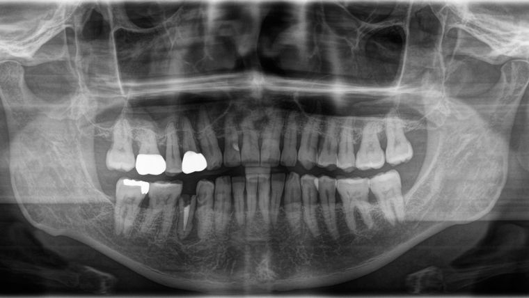 歯のレントゲン画像